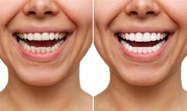 Uncovering the Power of Veneers